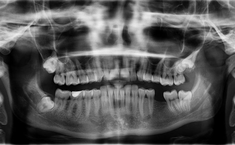 Zły sposób żywienia się to większe niedobory w jamie ustnej natomiast również ich zgubę